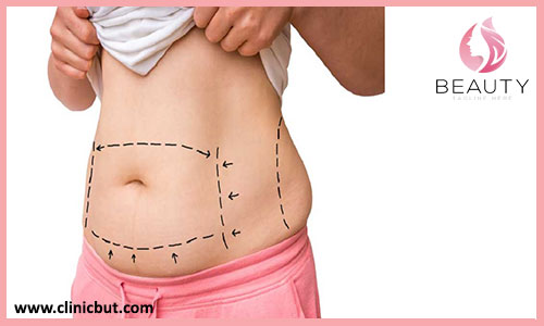 عوامل تأثیرگذار در سفت شدن شکم بعد از لیپوماتیک