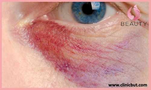 کبودی چشم بعد از مزوتراپی