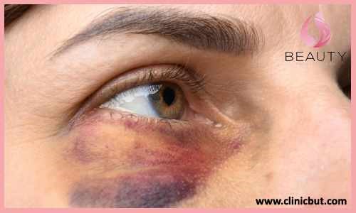 درمان کبودی چشم بعد از مزوتراپی